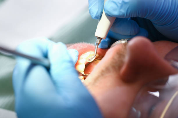Best Emergency Dental Care for Broken or Chipped Teeth in Glassboro, NJ